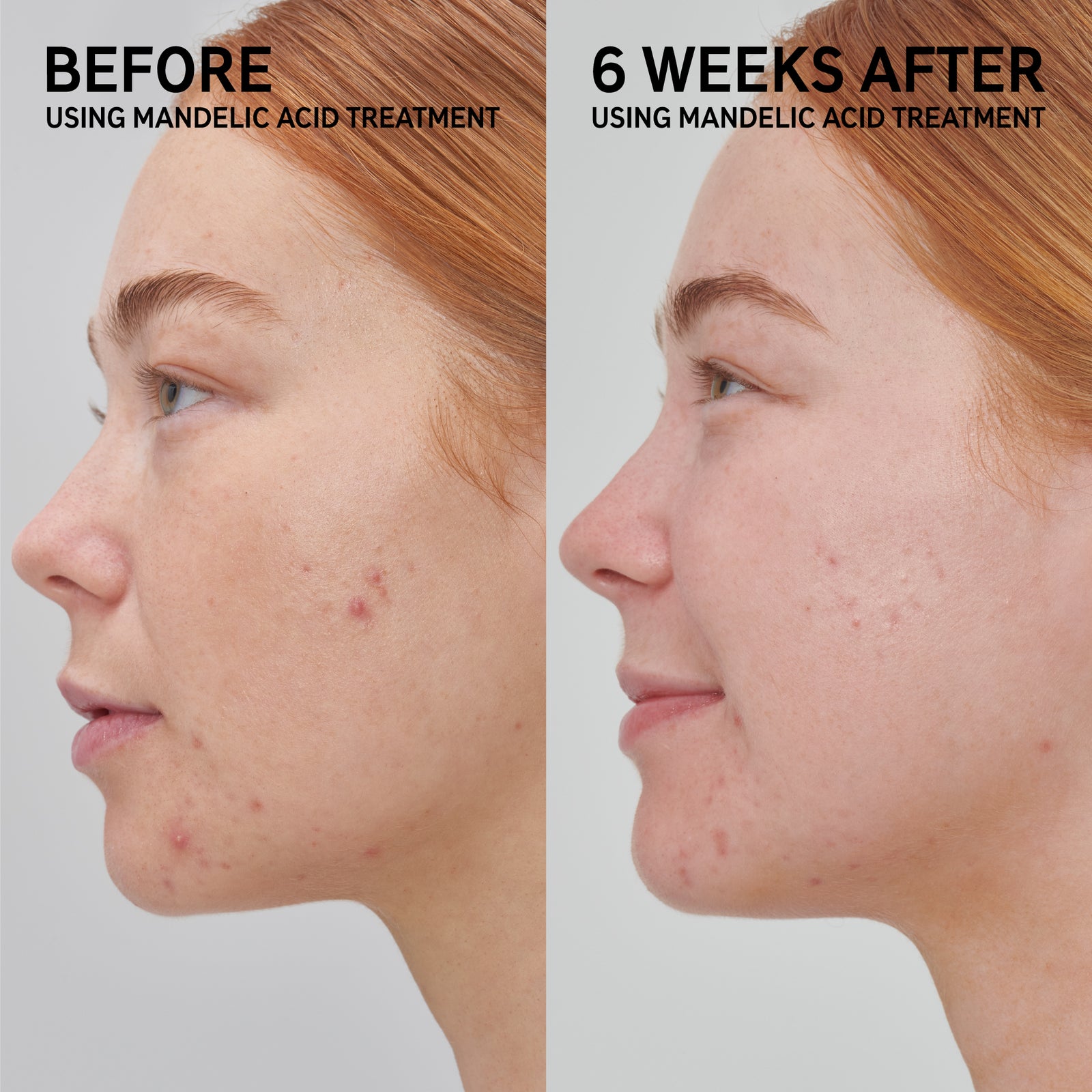 Mandelic Acid Treatment