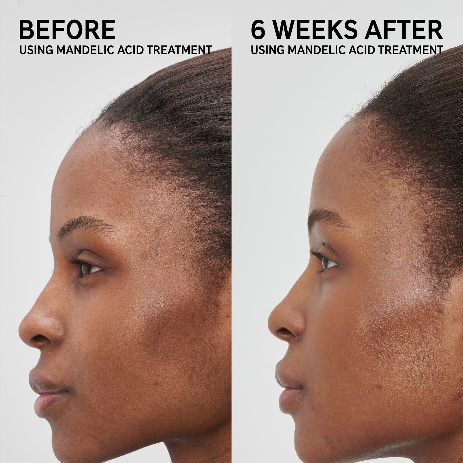 Mandelic Acid Treatment
